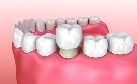 Dental Crown - Dentistry of Colorado