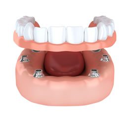 Implanted Dentures Denver
