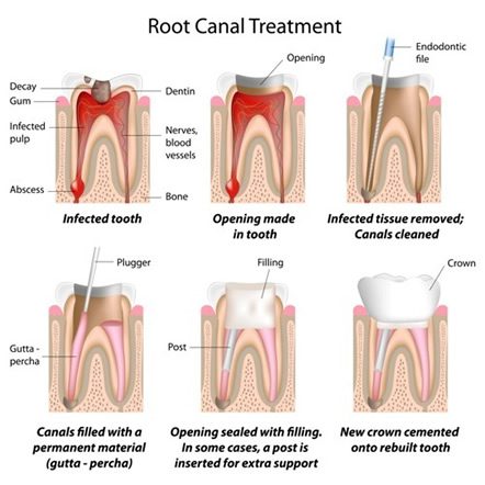 Root Canal Treatment Denver Dentist