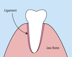 Tooth Extraction Illustration