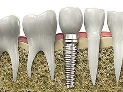 Dental implants - Dentistry of Colorado