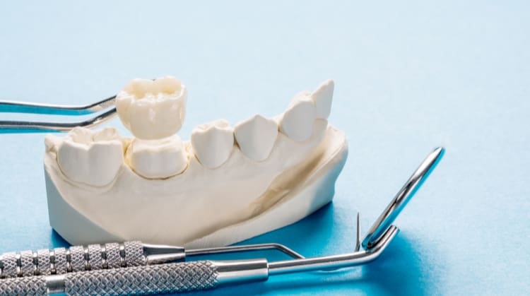 Dental crowns on a tooth model with dental tools.